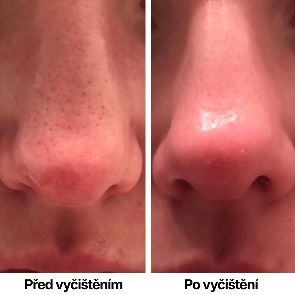 Skinforce: Vakuový vysavač pórů